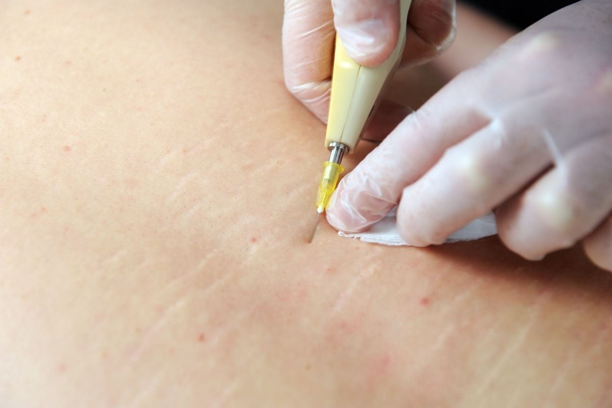 Carboxiterapia