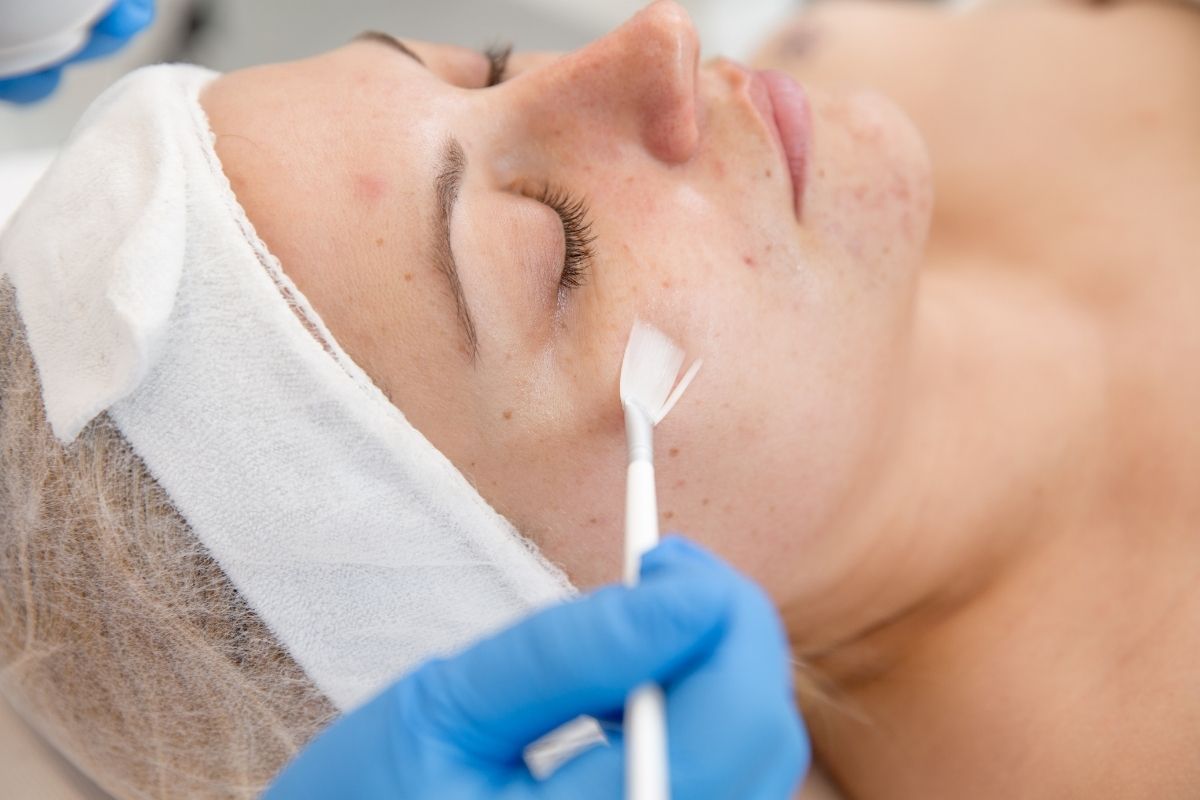 Peeling Químico