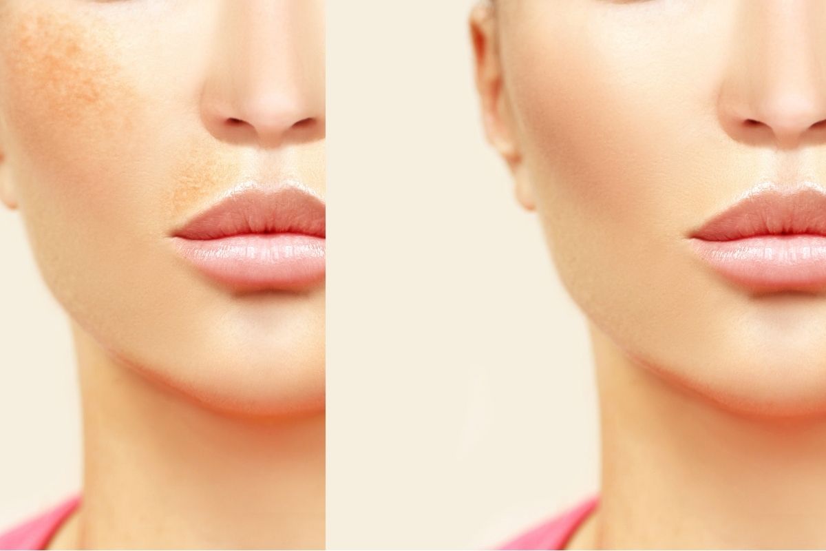 Programa Melasma Off